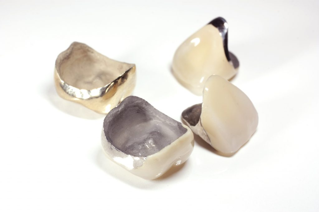 構造の一部や全部に金属を使用した歯科技工物